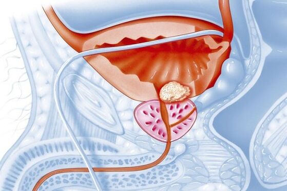 Processo infiammatorio della prostata