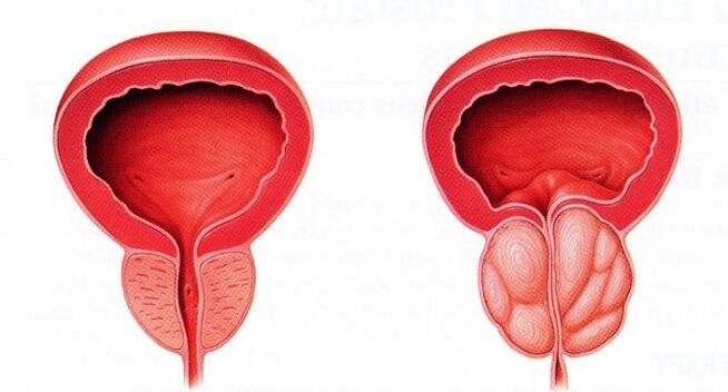 prostata sana e infiammata con prostatite cronica