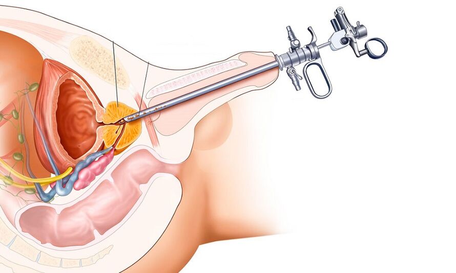 Trattamento chirurgico della prostatite