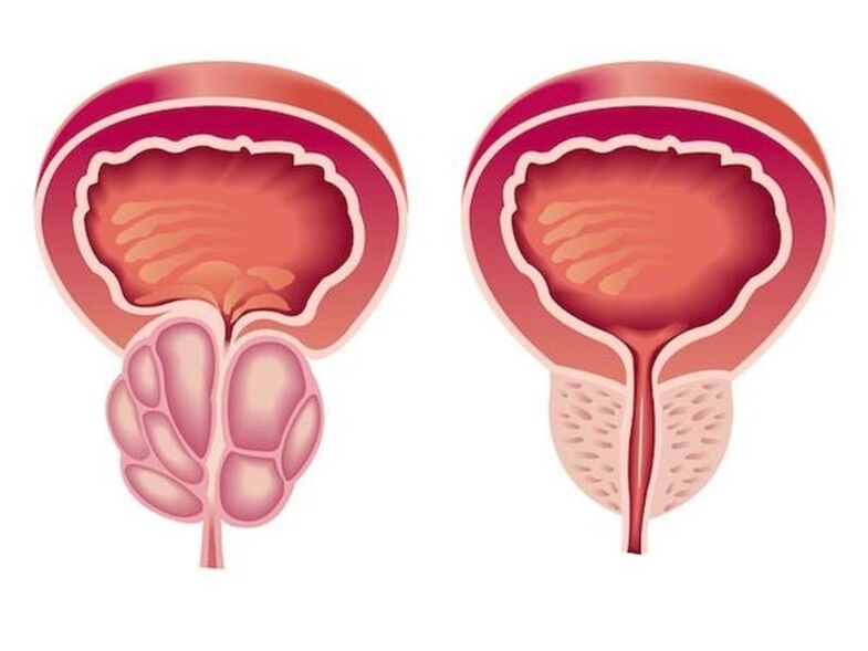 Che aspetto ha la prostatite
